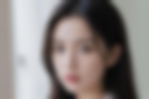 玻尿酸填充+3D显著