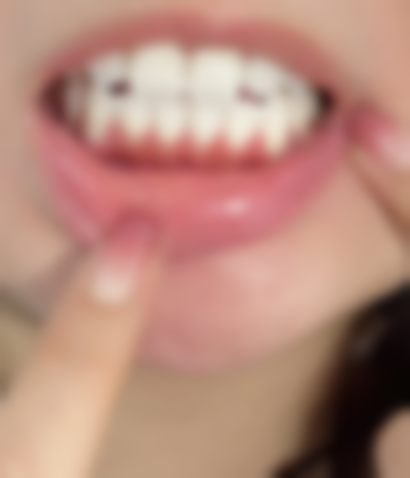 种牙后补牙的注意事项