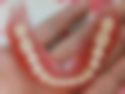 门牙缝隙大可以补牙吗？需根据缝隙大小、成因等判断，多种修复方案供专业医生评估选择！ 