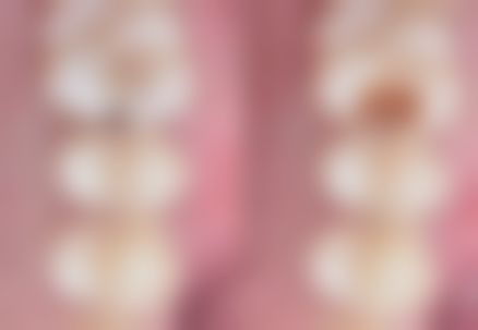 一岁宝宝出现地包天怎么办？先判断是否干预，再调整喂养等，日常注意清洁和训练！ 