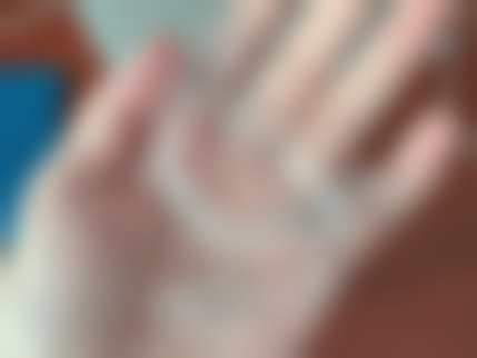 龅牙程度对拔牙决策的影响