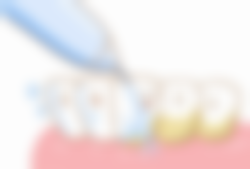 例假刚结束拔牙的注意事项