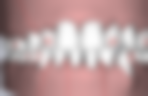 做了根管治疗还可以做牙齿矫正吗？一般能做但有特殊情况，需结合自身评估后决定！ 