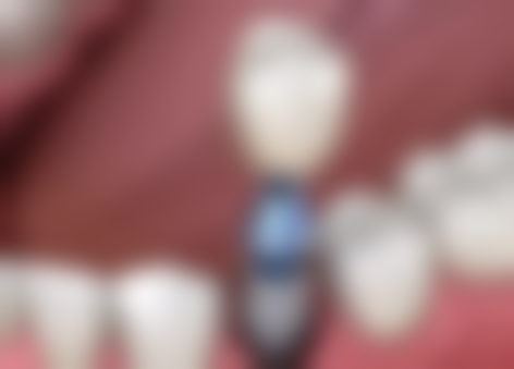 拔牙多久可以再拔第二颗？需综合创口、身体状况等，一般3天到2周，特殊情况另算！ 