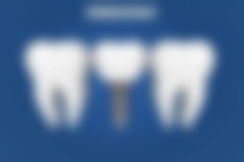 烤瓷牙什么材质比较好？全瓷、金属等各有优劣，需结合口腔、美观、预算选合适方案！ 