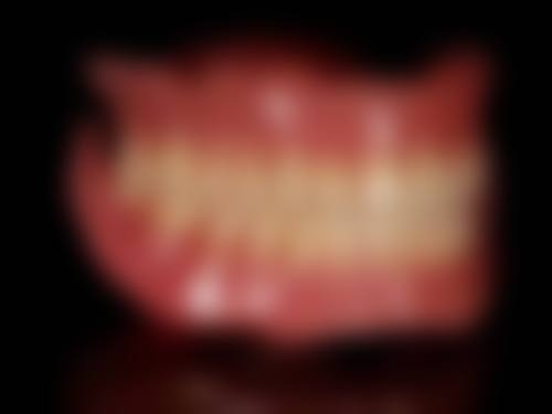 6岁小孩补牙需要套牙套吗？这要根据牙齿类型、损害程度判断，让专业医生来给您答案！ 