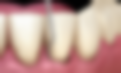 补牙和套牙套的目的