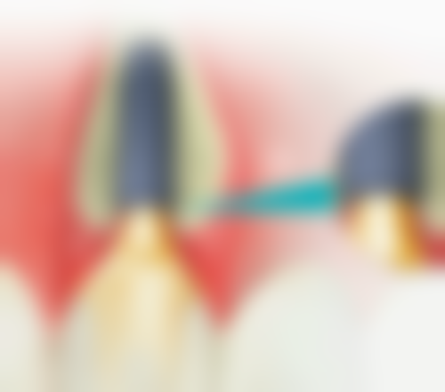 五、杭州国雅口腔万成锋医生技术怎么样？