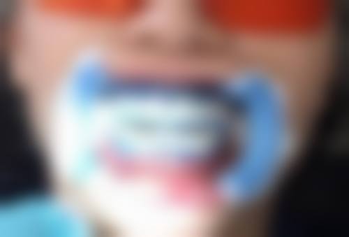 五、杭州国雅口腔毕文翔医生技术怎么样？