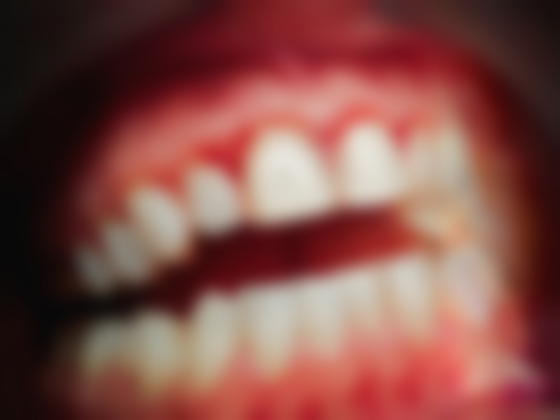 嘴突矫正必须拔牙吗？多种因素决定是否拔牙