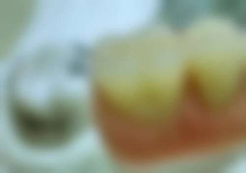 白醋可以洗牙结石吗？答案是否定的，白醋难溶结石还伤牙，科学处理方法在这！ 