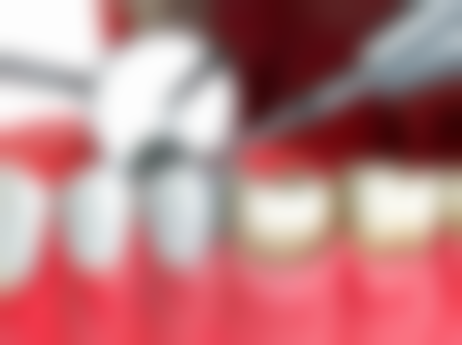 六、杭州国雅口腔张虹医生口碑评价及真人实例反馈