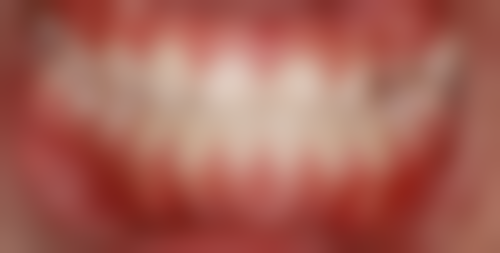 拔牙齿不补会怎么样？会致咬合紊乱、牙列错乱，还影响美观与发音，加大修复难度！ 