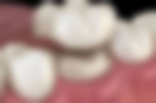 拔牙前后的注意事项