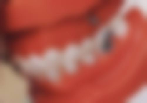 14岁洗牙需要注意什么？