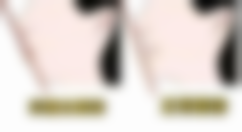 嵌体补牙和牙套哪个好？各有适用场景，需结合缺损程度、修复需求等多方面综合考量！ 