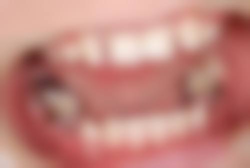 五岁孩子牙疼又不配合补牙怎么办？可从多方面入手，如选专业科室、分散注意力等解决！ 