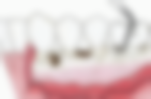 拔牙能一次性拔两边智齿吗？需综合创伤、恢复、身体状况等因素，医生会制定个性方案！ 