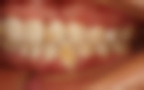 烤瓷牙有什么优缺点吗？优点如美观耐用适用广，缺点有磨牙过敏影响检查等需考量！ 