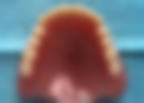 5岁男孩牙齿地包天需要矫正吗?取决于具体情况，多数需及时矫正，把握3 - 5岁最佳时机！ 