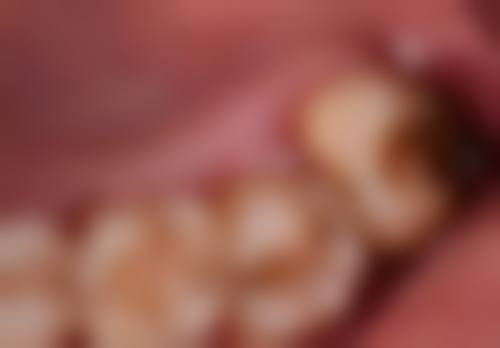 韩国sg种植牙怎么样？从优势局限、与其他品牌对比及寿命等多方面为你全面解析！ 