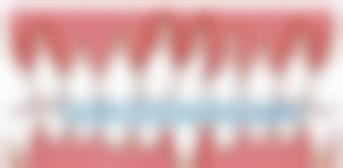 韩国sg种植牙的局限