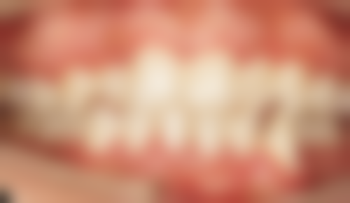 掉了牙可以种植牙吗？选择正规机构至关重要