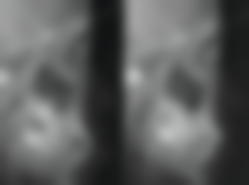 洗牙后可以立马补牙吗？需视牙龈状况、龋坏位置而定，一般情况建议等敏感缓解 