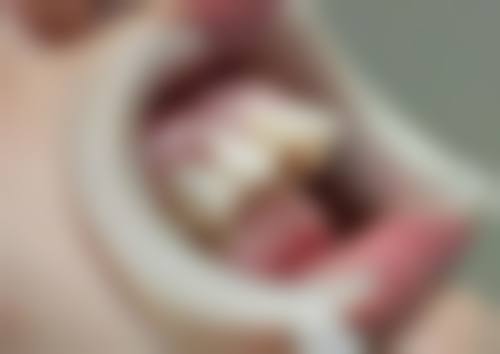 牙疼用根管治疗怎么样？它能消除炎症保存患牙