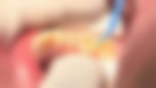 六、南充爱心口腔何琴医生口碑评价及真人实例反馈