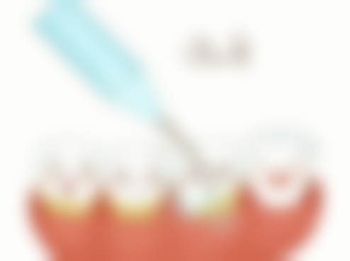 补牙位置对树脂补牙时长的影响