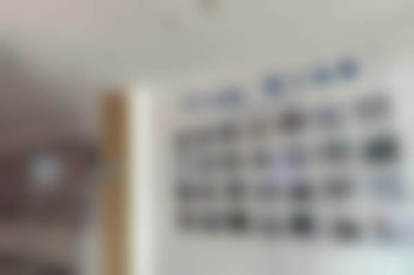 【儿童补牙】玻璃离子补牙 | 龋齿坏牙虫牙限首颗医生优势