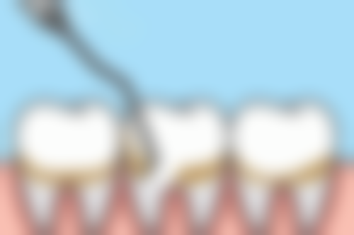 化疗后拔牙的注意事项