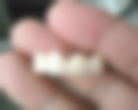 北京京大博爱口腔门诊部进口自锁金属托槽矫正的其他优势