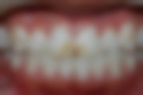 拔牙后安活动牙好吗？再看看活动牙存在的不足之处