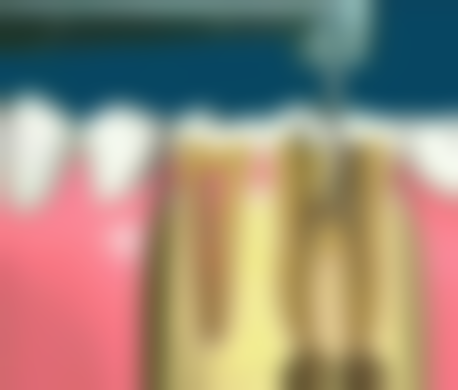 种植牙和隐形义齿的缺点