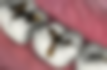 补牙用光固化树脂好吗？它色泽美观成本低，但有变色老化风险，优缺点需综合考量！ 