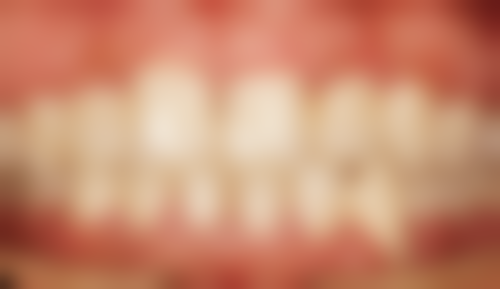 50岁后可以做牙齿矫正吗？多数情况可行但有条件，需评估口腔状况并遵长期维护之道！ 