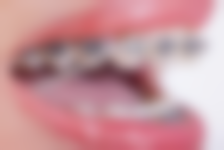 洗牙技术不好可能加重牙周病