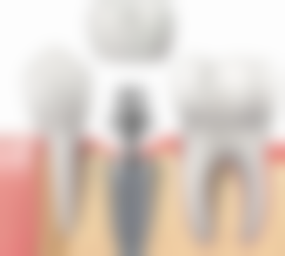 种植牙材料的未来发展趋势