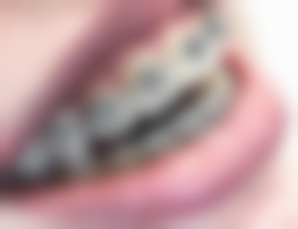 地包天对心理的影响