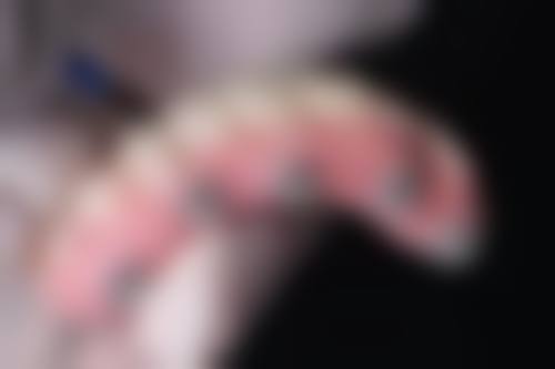 戴烤瓷牙矫正牙齿的注意要点