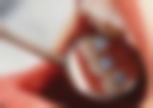 口臭通过洗牙可以去除吗? 洗牙效果因诱因而异，非口腔问题洗牙难以根治，需针对性治疗！ 