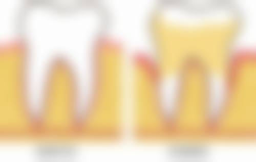 板牙做活动义齿后的护理要点