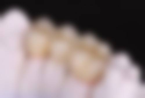 拔牙后的护理要点