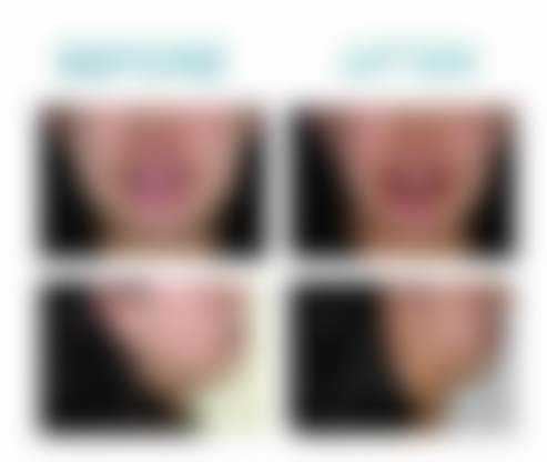 北京禾禾美美口腔李昌龙舌侧全隐形矫正40000元起，全隐形美观，高效精准矫正牙齿