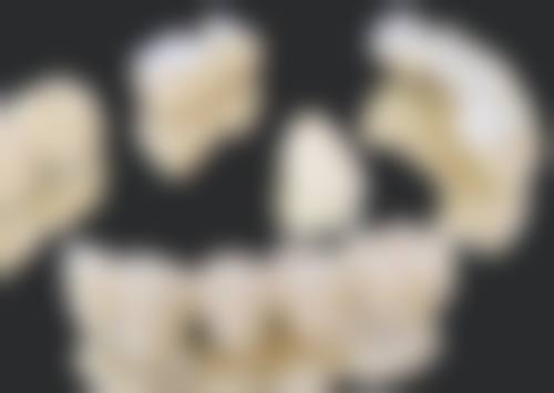 延期种植——耐心等待后的理想修复