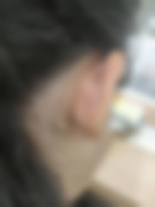 患者真实评价深圳呈悦医疗美容门诊部芭比亚沙维亚医生
