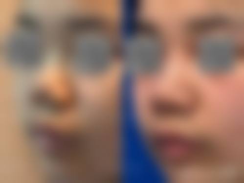 擅长项目详解:南昌大学第二附属医院李小林医生技术优势