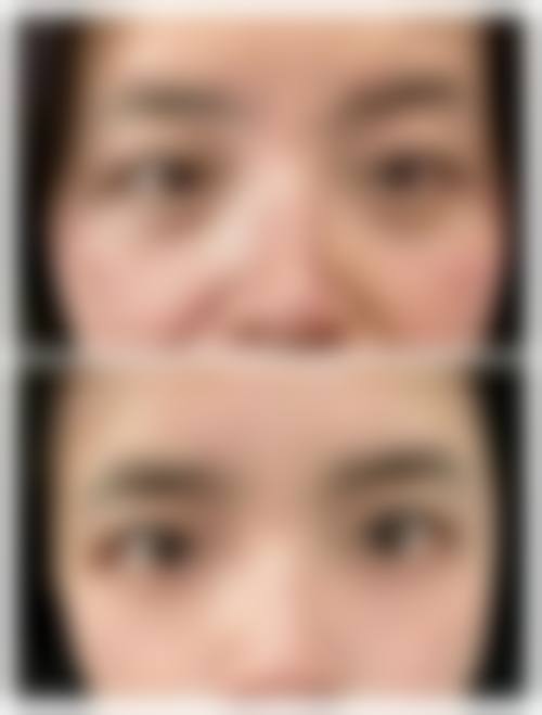 临床实例分享深圳美臣整形美容门诊部张小川